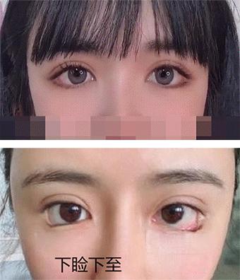 为什么医生不建议去三甲医院整形,为什么医生都不推荐做眼睑