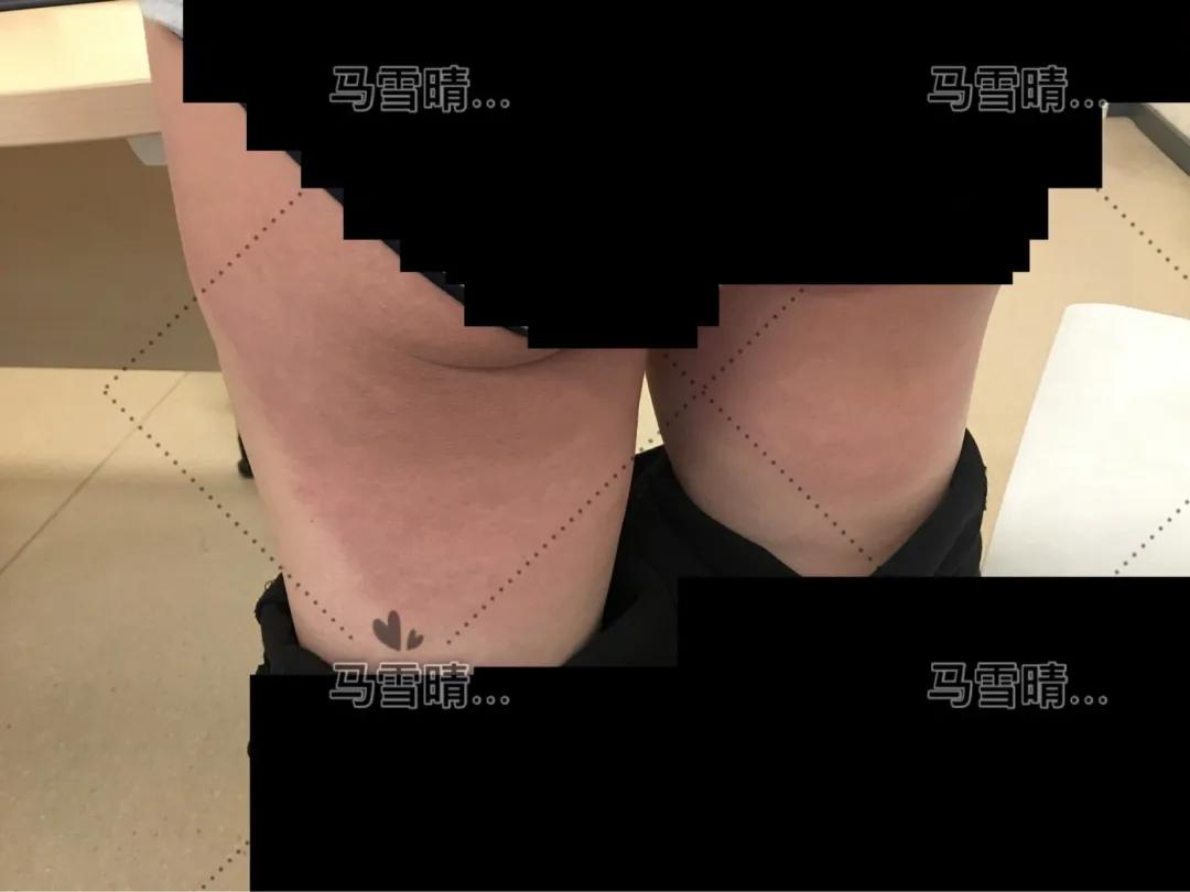 怀孕腋窝腹股沟腘窝起成片的疹子,妊娠皮疹是怀的多是男孩