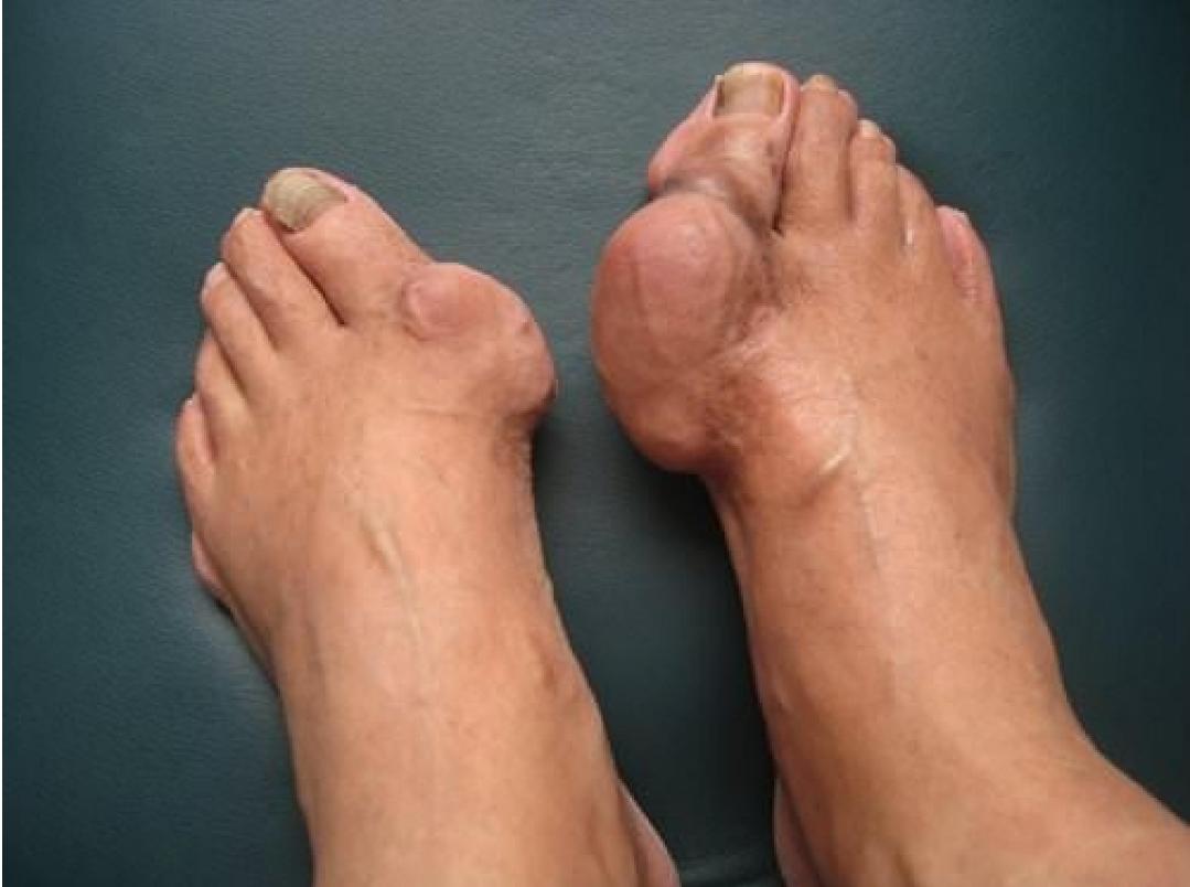 痛风关节结晶石的消除办法有哪些,痛风石溶解能根治痛风吗