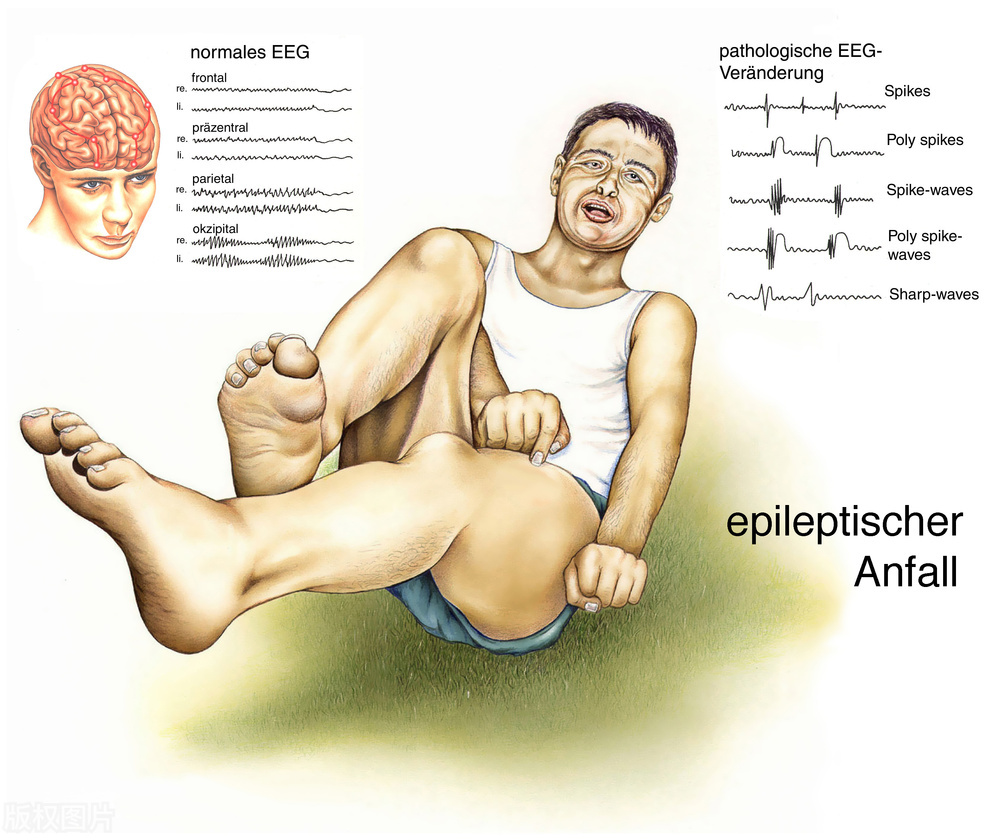 癫痫发病临床特点,癫痫根据病因和发病机制分为哪些