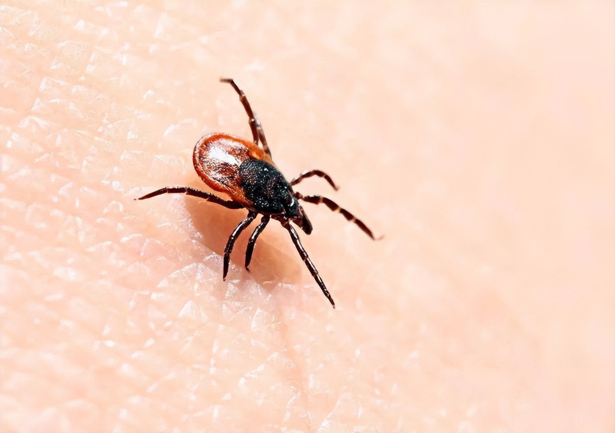 女子体内有蜱虫被医生拿镊子拔出,女子身上长虫医生拿镊子治疗