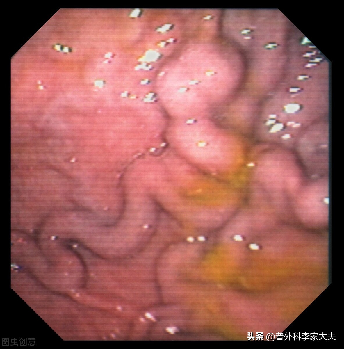 肝癌中晚期拉血,肝癌晚期拉血止不住怎么办