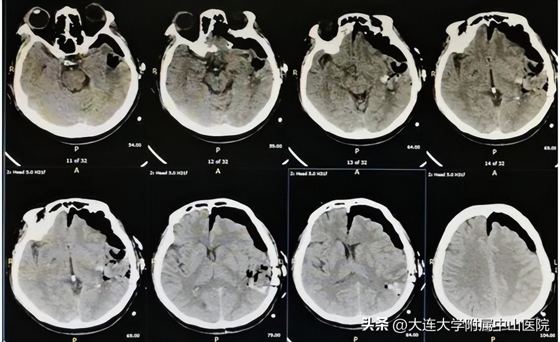 切口清除脑内血肿,内镜下脑内血肿清除的原理