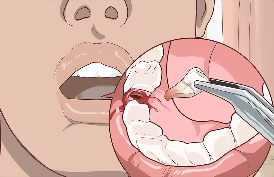 拔牙后伤口好了牙龈肿痛,拔牙后牙龈如何快速消肿