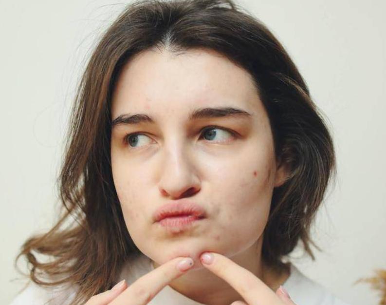 脸上爱出油是什么原因导致的,脸上长痘痘爱出油是什么原因