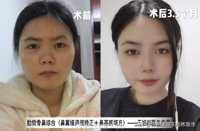 常见鼻部整形美容项目,整形鼻和自然鼻