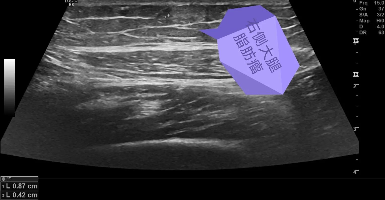 身体腰背部腹部两侧有小硬疙瘩,大腿和腰部起了大片的疙瘩