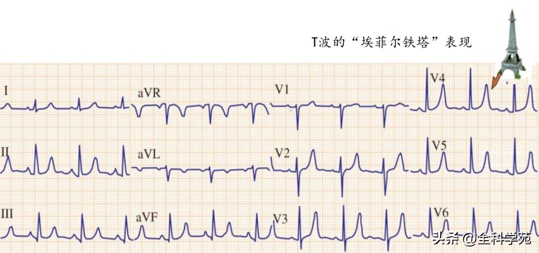 t波高尖心电图判断标准,t波高尖判断标准