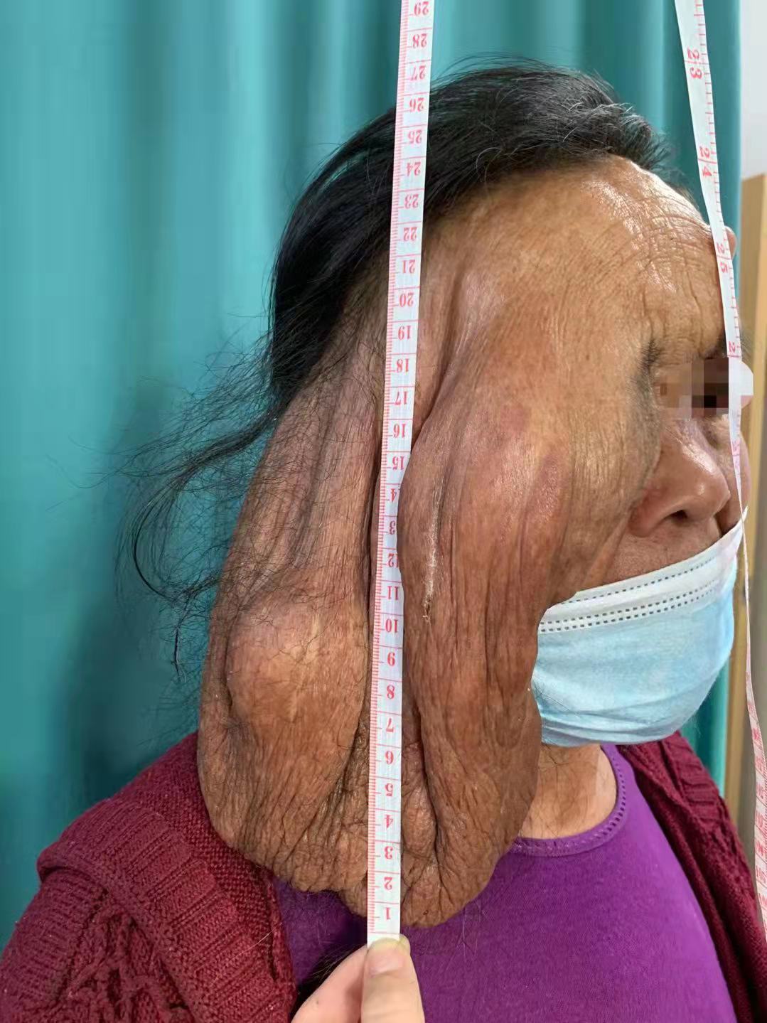 “小米粒”51年后变“大肉帘”！武汉大学人民医院整形专家摘除罕见面部巨大神经纤维瘤