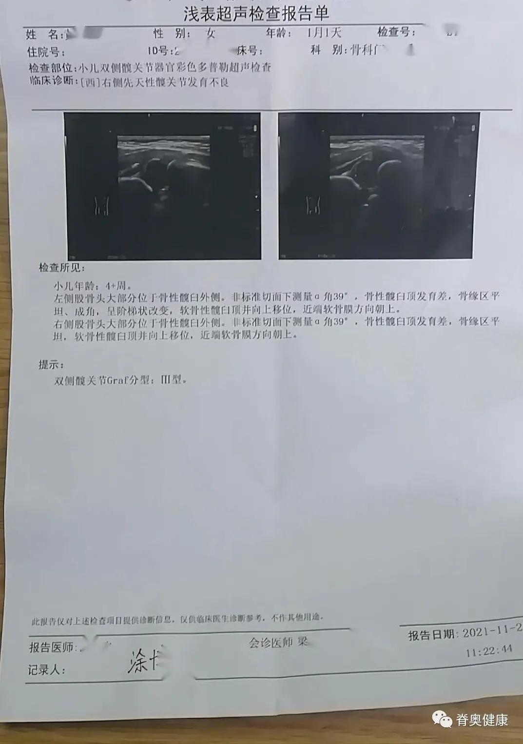 脊奥健康｜婴幼儿矫正案例—先天性髋关节发育不良+Tübingen支具