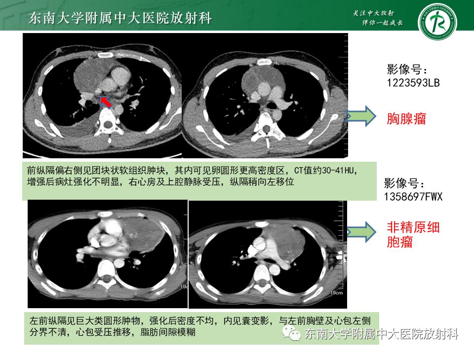 好文分享值得深思,纵隔精原细胞瘤