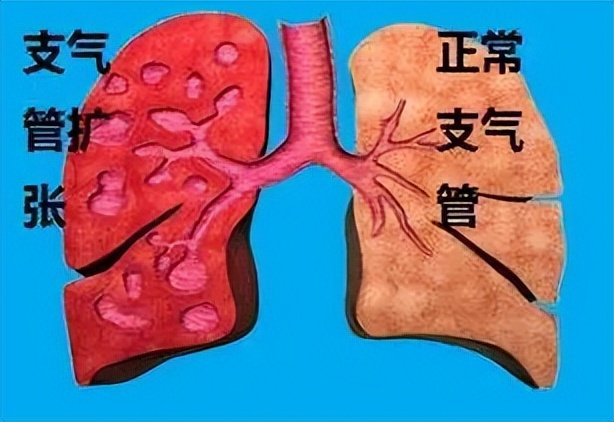 如何治疗支气管扩张的最好方法,治疗支气管扩张最好的办法有哪些