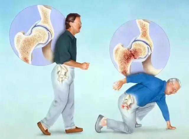 胯骨骨折被称为人生最后一次骨折,为什么叫人生最后一次骨折