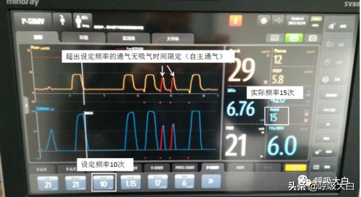 呼吸机设置：呼吸频率+吸呼比
