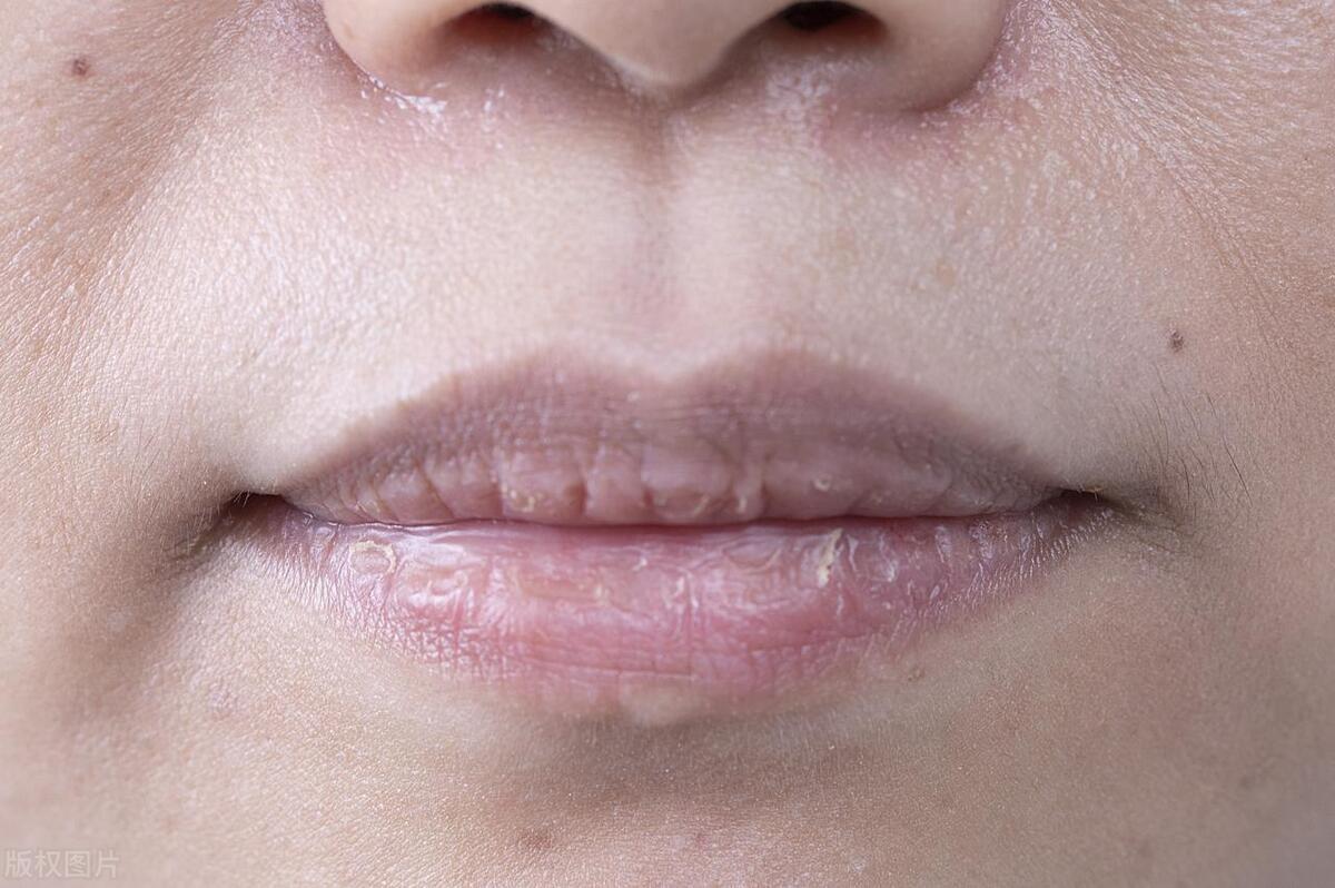 法令纹有多难看,法令纹是不是天生的