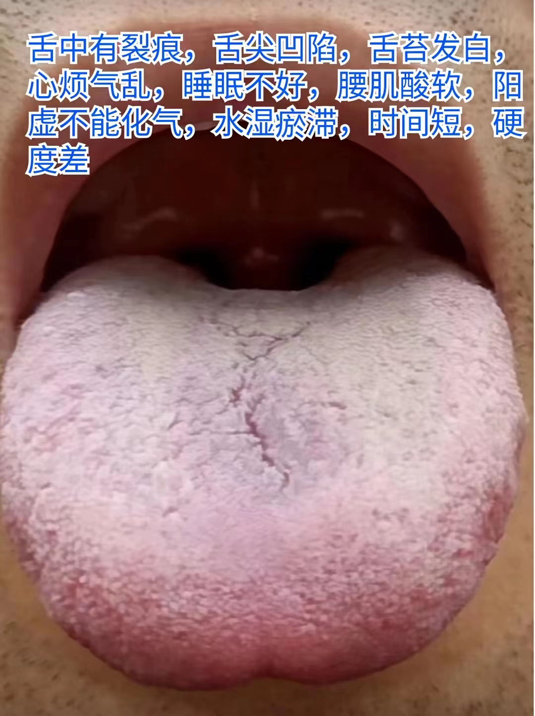 今日舌诊,舌尖舌根凹陷中医辨证