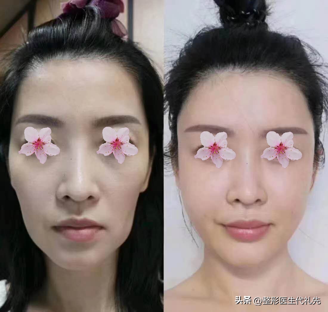 脂肪填充苹果肌刚填充的效果,填充苹果肌用什么填充