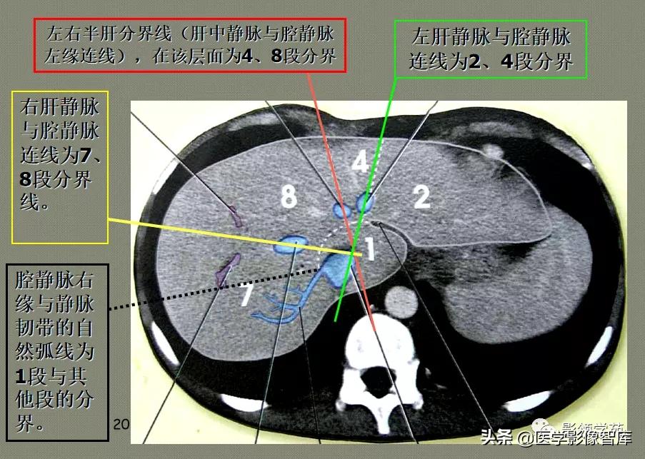 肝脏影像分叶分段解剖图,肝脏分段解剖图谱