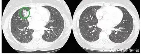 抗癌新突破特效药,突破精准抗癌药