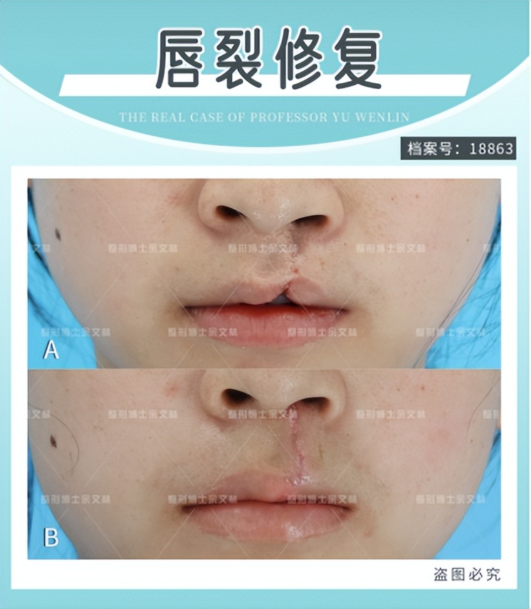 唇隐裂能完全修复吗,唇隐裂痕迹怎么消除