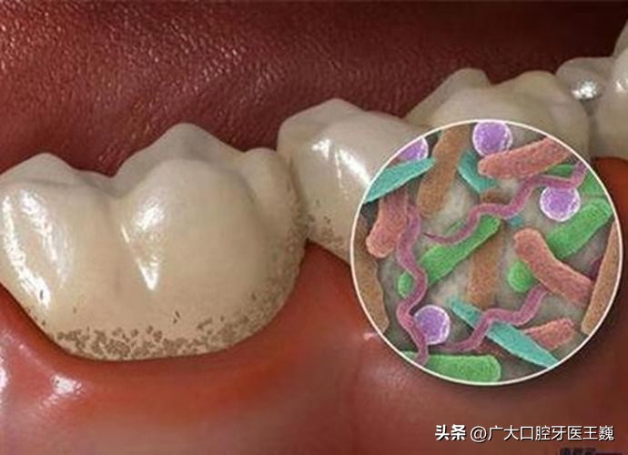 牙齿老是发黄有牙渍怎么办,牙齿里面根部黄渍去除小妙招