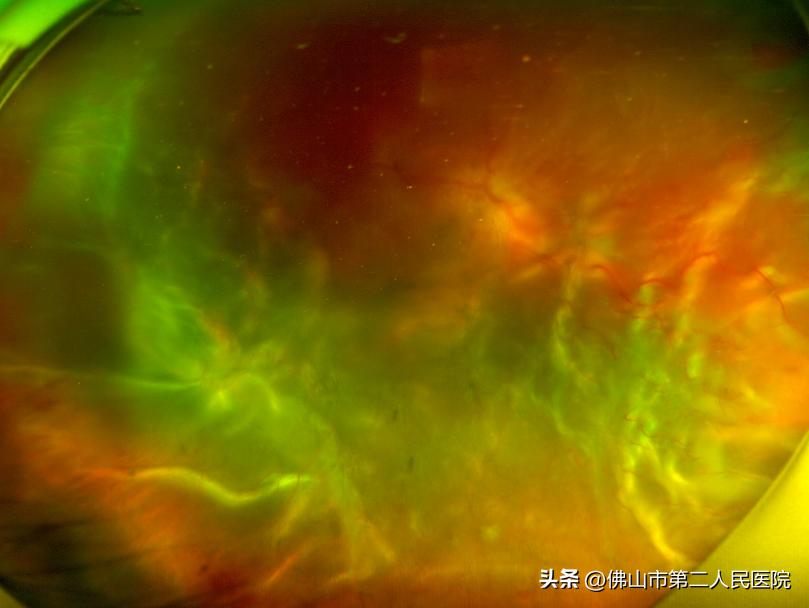 眼睛突然看不见视网膜脱落,视网膜脱离眼睛失明能看好吗