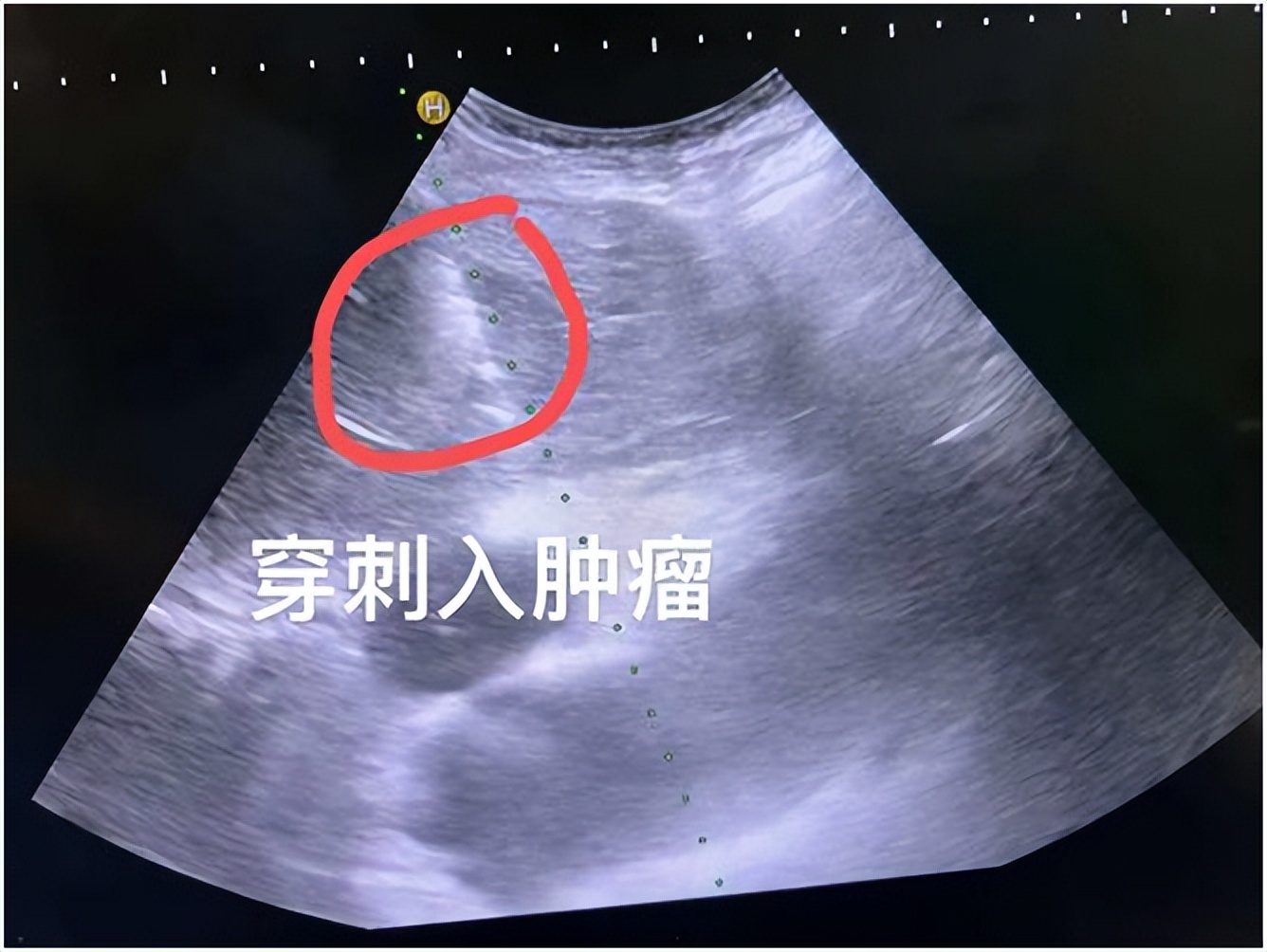 肝癌复发可用激光治疗吗,9公分的肝癌可以做微波消融么