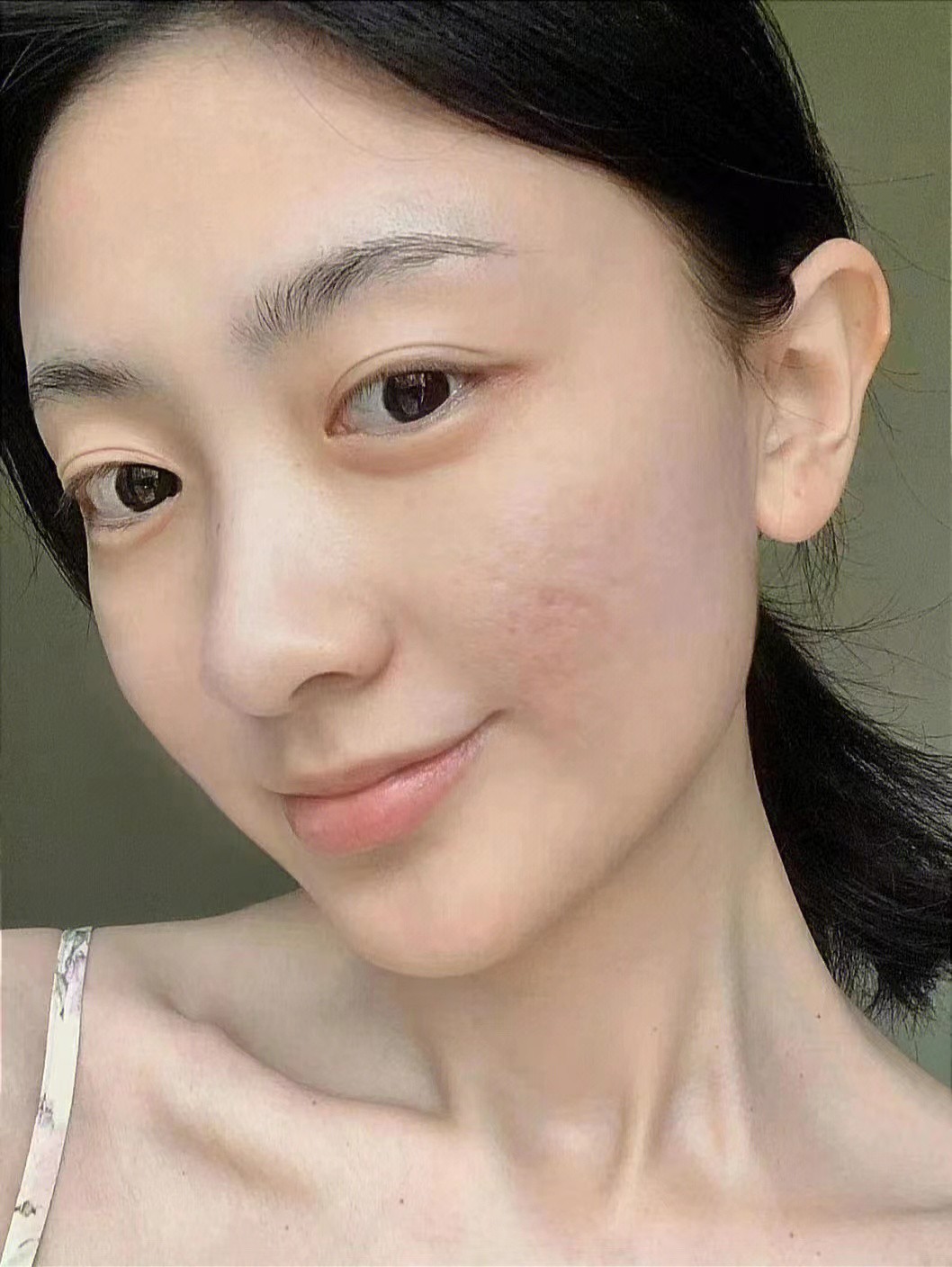 脸上长痘痘坑快速消除,脸上长痘怎么祛痘印痘坑