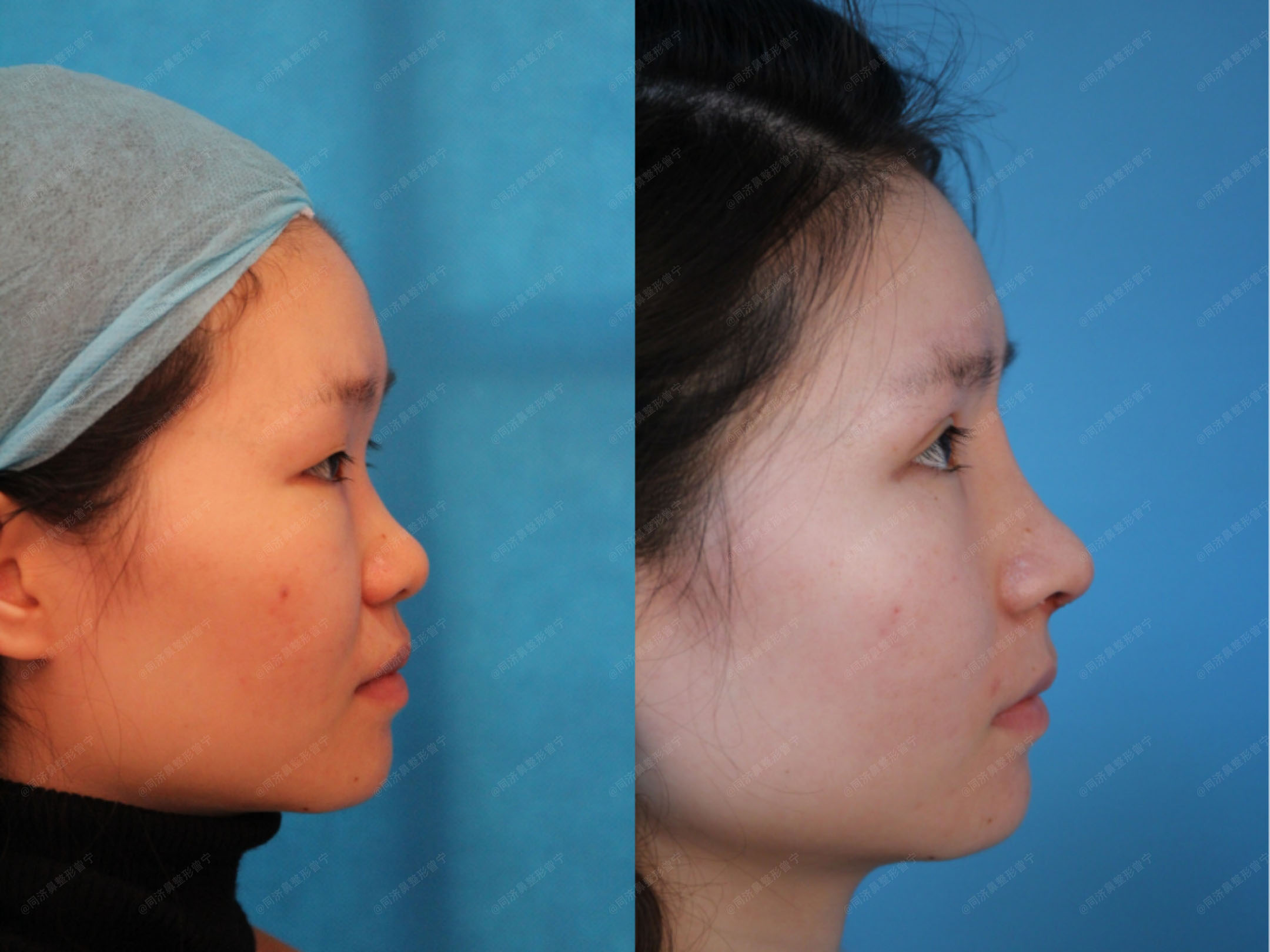 整形手术鼻综合包含哪些项目,鼻整形抖音必火话题