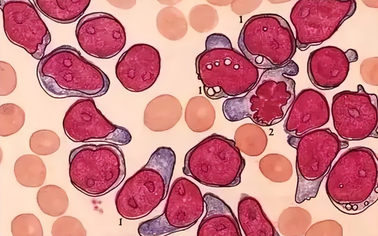 过敏性紫癜挂哪个科室,过敏性紫癜在血液病中严重吗