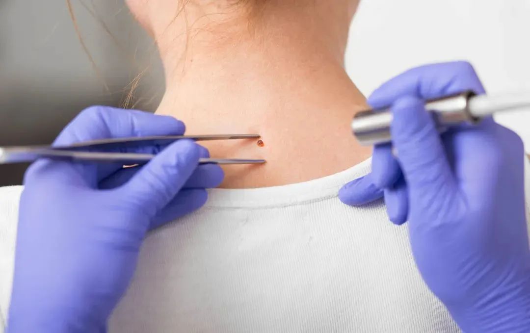 如何判断新长的痣是不是黑色素瘤,正常痣和黑色素痣图片对比说明