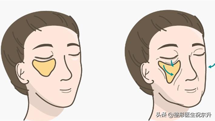 口角纹和法令纹去除方法,法令纹嘴角纹去除最好的方法