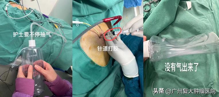 气胸怎么做气管镜封堵,气胸穿刺抽气堵住了怎么办