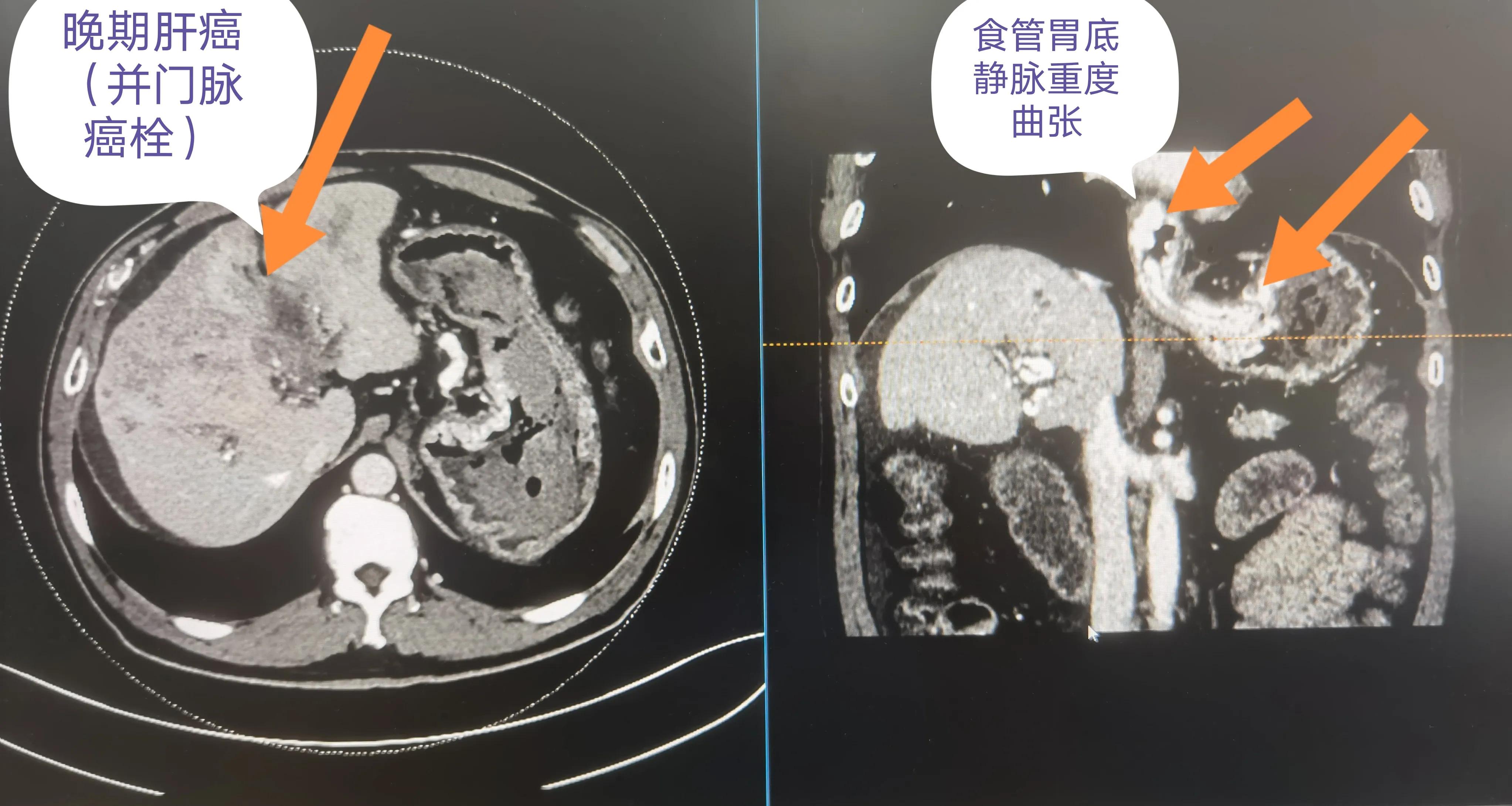 肝癌晚期伴胃溃疡出血,肝癌晚期合并脑卒中