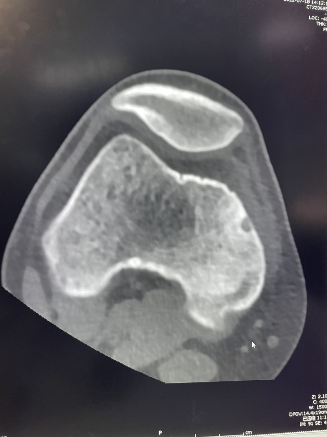 西安市红会医院康复疼痛科,西安红会康复疼痛科