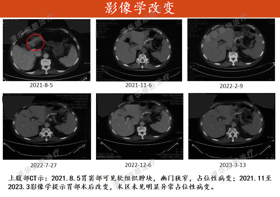 2年前被查出胃印戒细胞癌,现在还好吗?