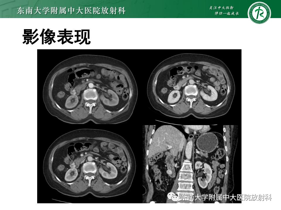 小肠间质瘤最新治疗中药方,小肠间质瘤基因检测