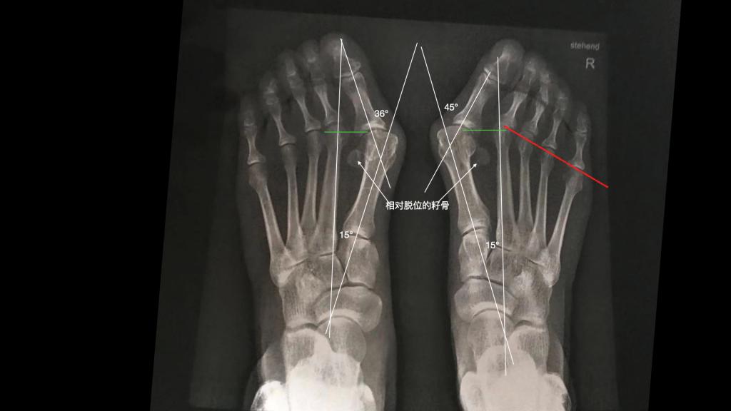 痛风与脚拇指外翻区别,痛风和大脚拇指外翻有何区别