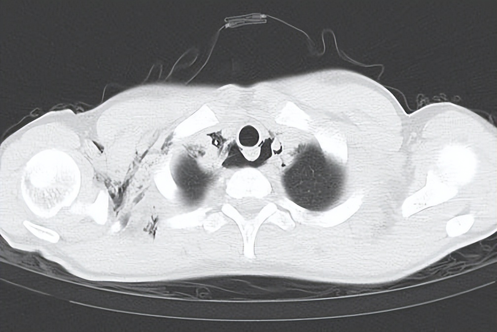 急性咽炎医生建议住院,咽炎有必要去医院急诊看吗