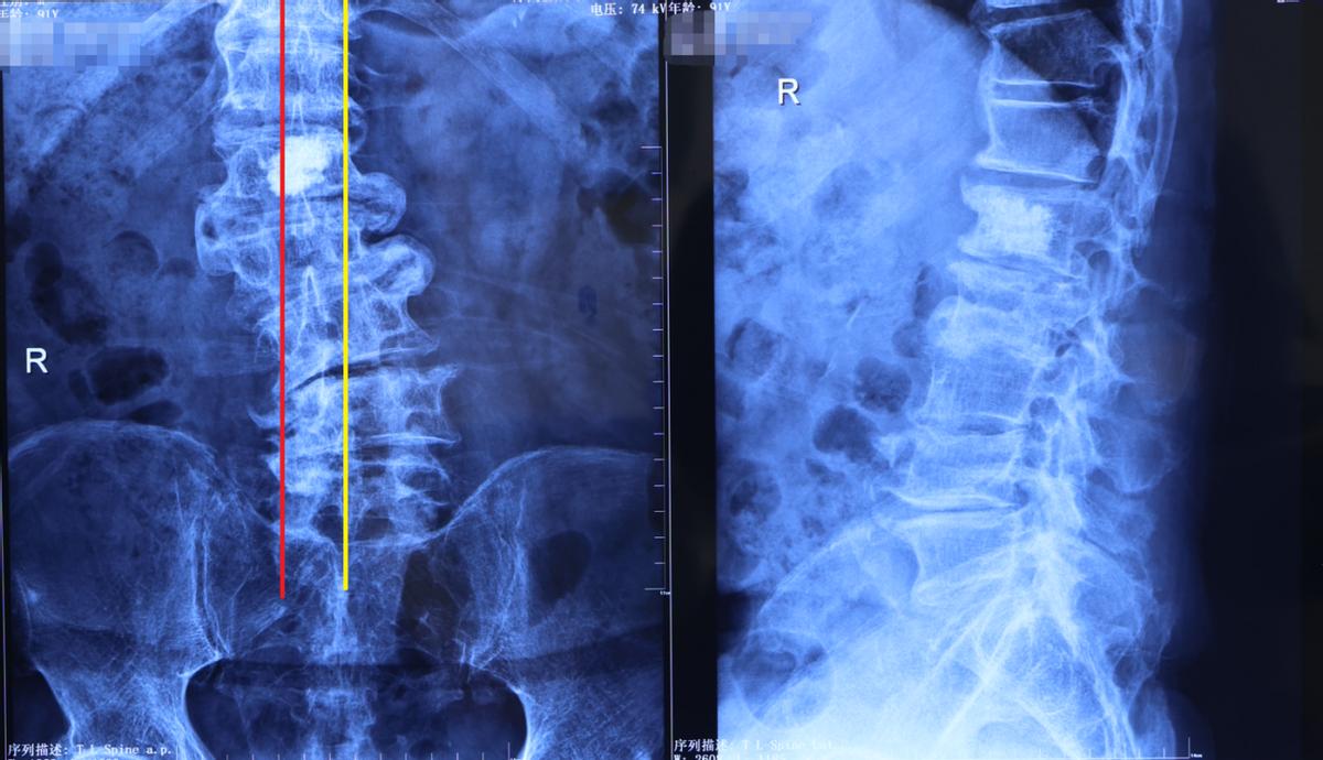 脊柱侧弯腰椎变性,70岁老人腰椎侧弯严重