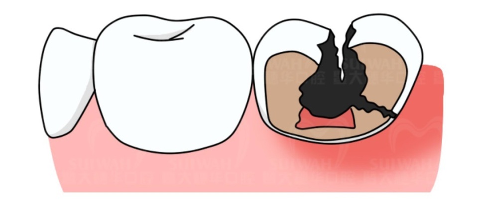 冷热酸甜，想吃不能吃？牙齿敏感怎么办？