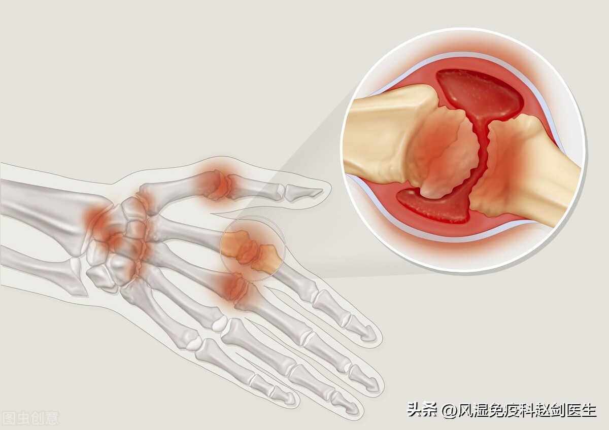 类风湿性关节炎用什么激素好,类风湿关节炎必须用活血药吗