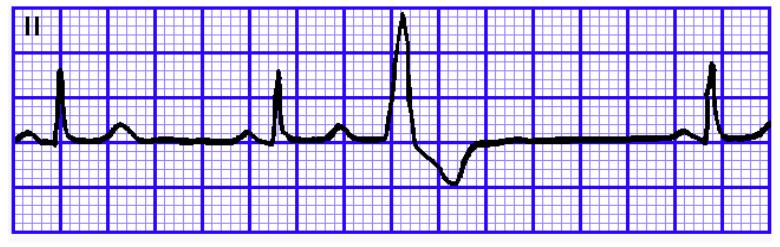 心律失常四型,心律失常四肢乏力胸口难受