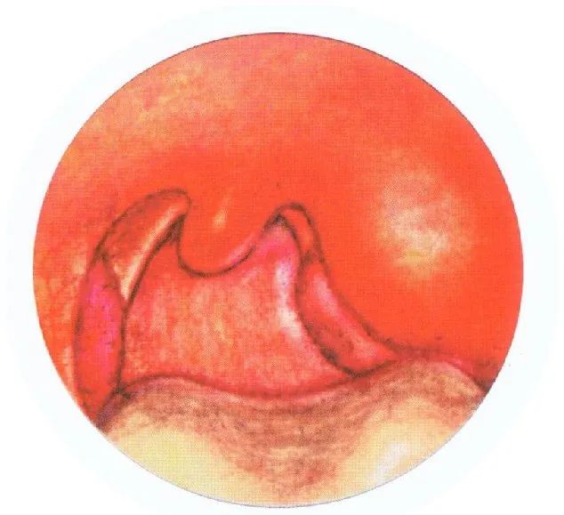 咽喉脓肿临床表现,咽旁脓肿临床表现与治疗