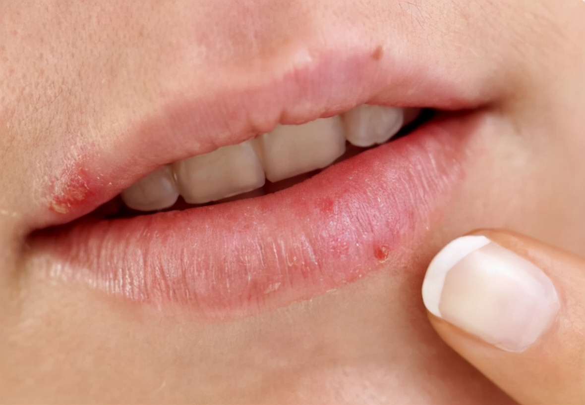 嘴巴旁边很多小水泡会留疤吗,嘴巴周围长一堆小水泡是上火吗