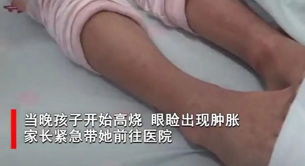 被毒虫咬后需谨慎,被毒虫咬后的有效处理