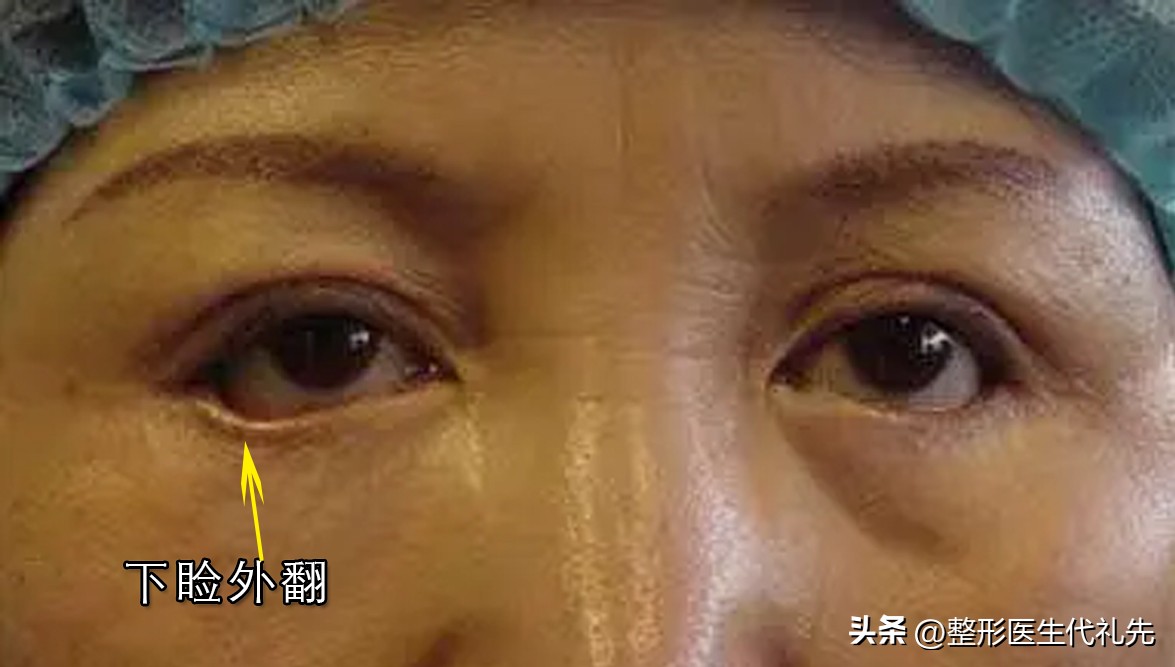 眼袋失败修复真实案例,眼袋手术失败怎样去做鉴定