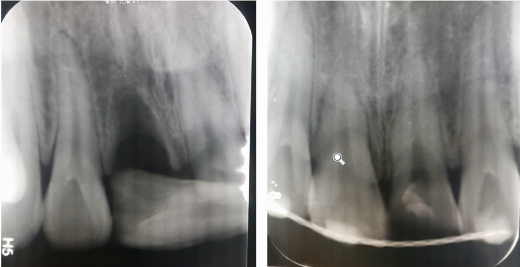 牙齿受外伤吃什么对牙好,牙齿受损伤引起牙痛怎么办