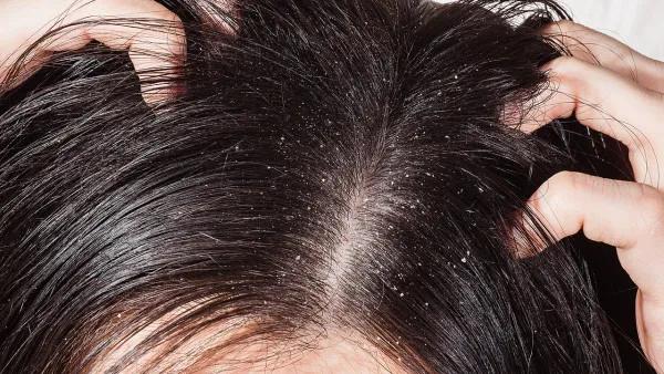 头皮脂溢性皮炎头屑多怎么治疗,头皮痒头屑多是脂溢性皮炎吗