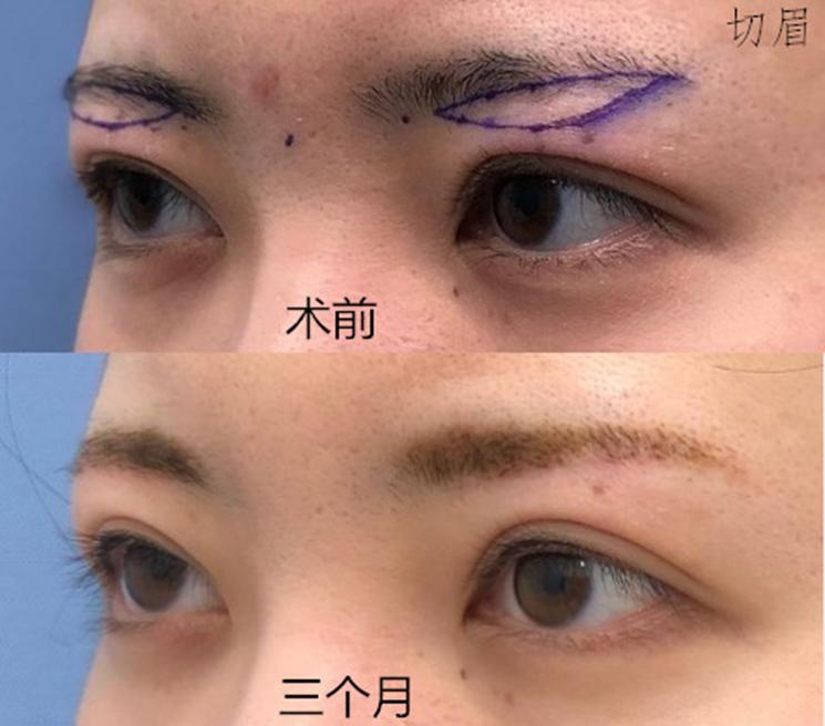 切眉和提眉哪个效果好有副作用吗,想做提眉和眼袋手术